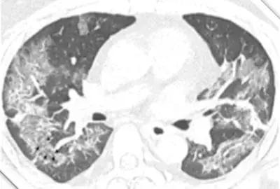 Assistência Respiratória no Paciente com Novo Coronavírus (2019-nCoV)