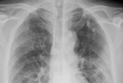 Síndrome respiratória aguda severa